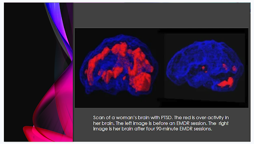 EMDR Brain Scans